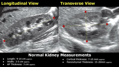 renal cortical thickness normal range